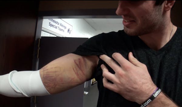 Ponder shows off his bruised arm